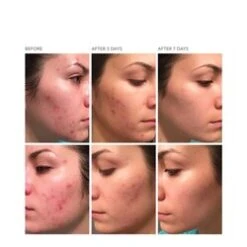 Dr Dennis Gross DRx Acne Eliminating Gel -Care Products DRx Acne Eliminating Gel add3 65307 8319 general